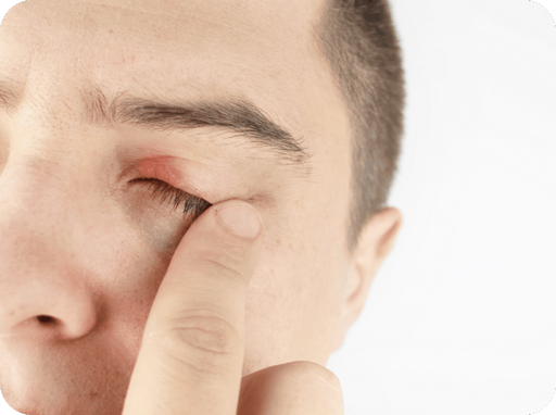 Blepharitis / Chalazion